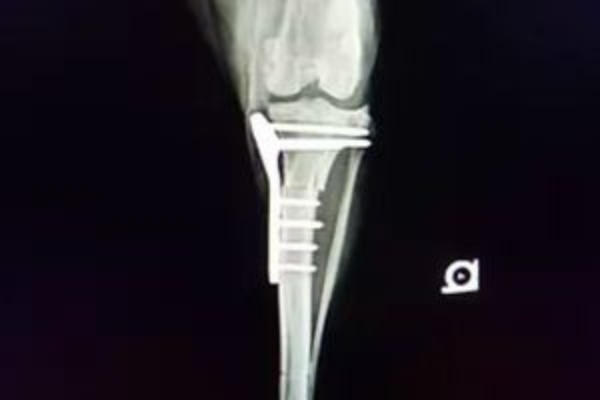 X-ray fracture repair
